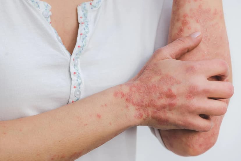 miller eszter psoriasis 5996424 1920